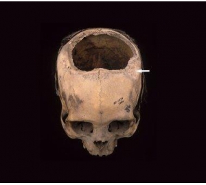 Древние инки превосходили хирургов середины XIX века в искусстве операции на черепе